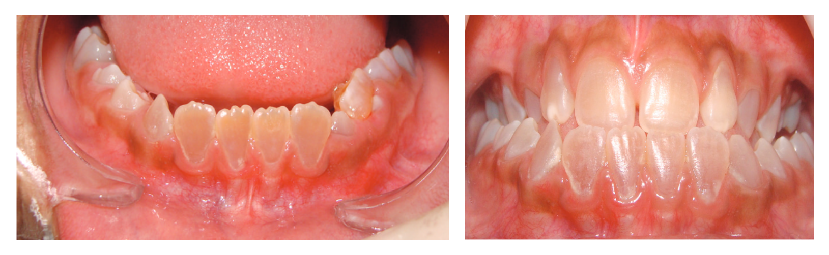 fig-semio-boca-osteogenese