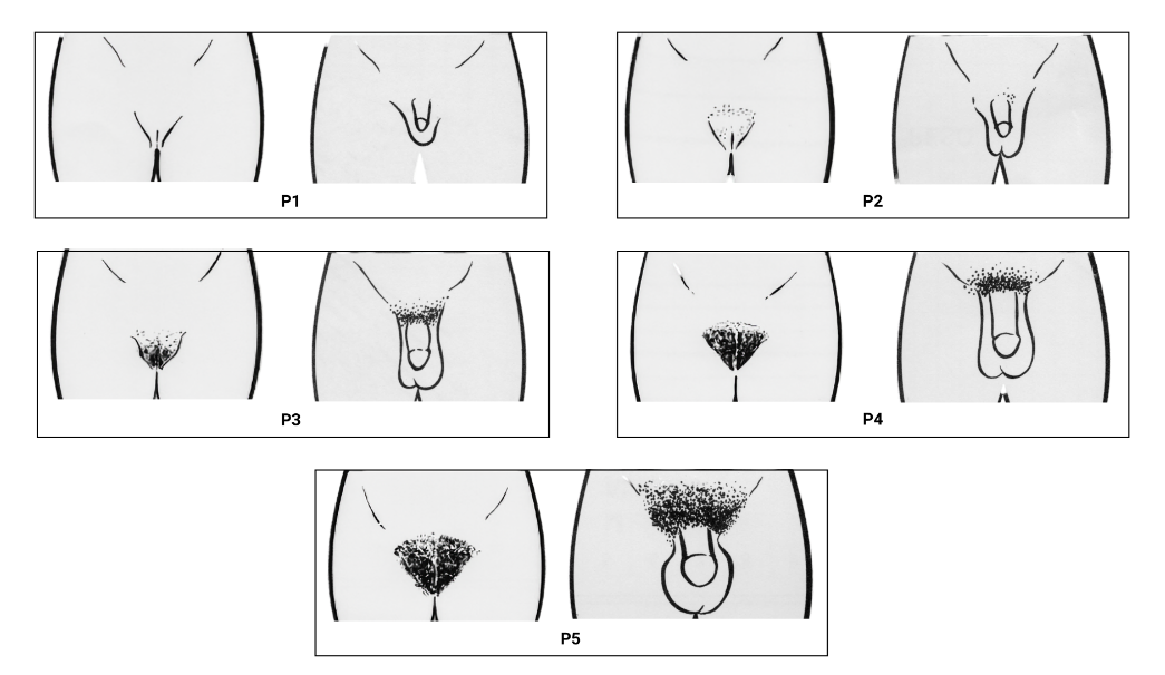 fig-semio-estadiamento-puberal-pelos