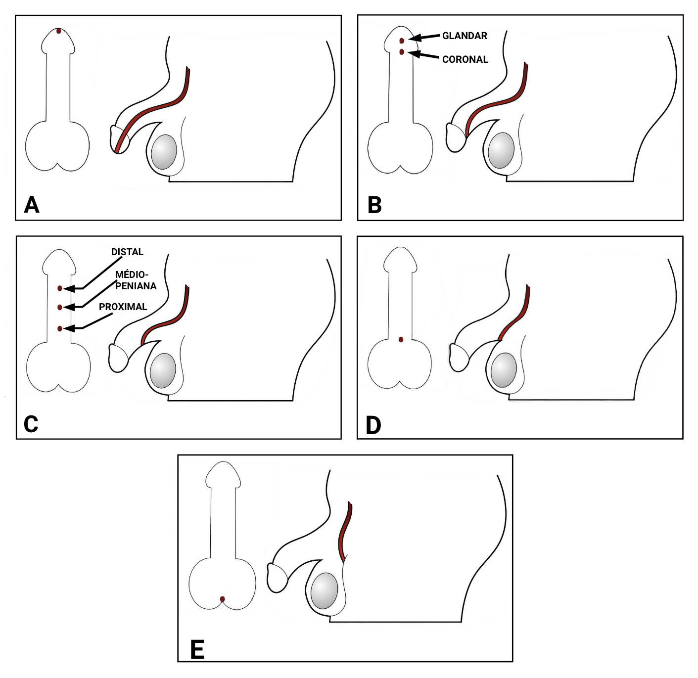 fig-semio-hipospadias