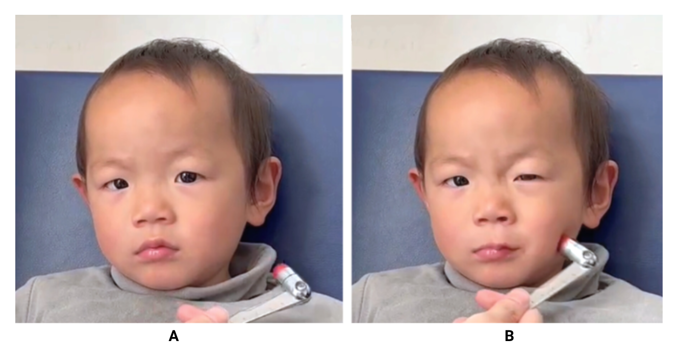 fig-semio-sinal-chvostek