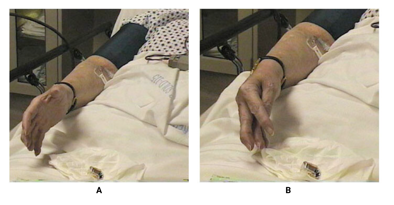 fig-semio-sinal-trousseau