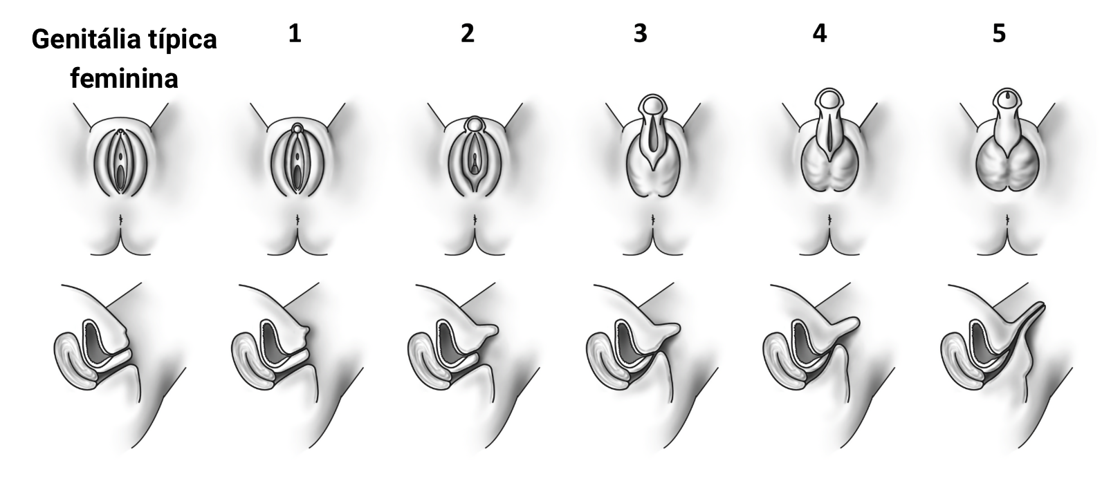 fig-semio-virilizacao-prader
